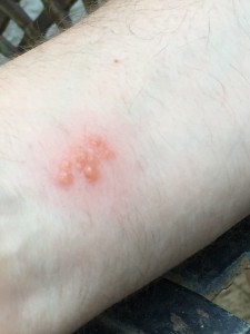 Bug Bites Airbnb Gozo