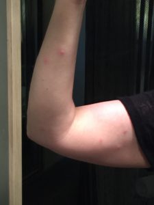 bedbugs luxury hotel covered in bug bites