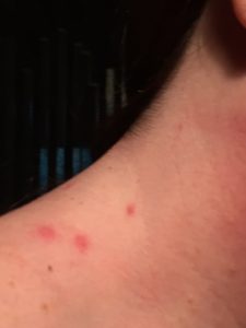 bedbugs luxury hotel covered in bug bites