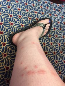 bedbug luxury hotel covered in bug bites legs